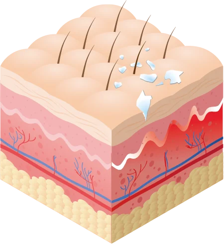 Imagem vetorial de pele com efeitos calcários devido a águas residuais sem utilizar a misturadora monocomando OPTIMAL 360º da Hidrosalud